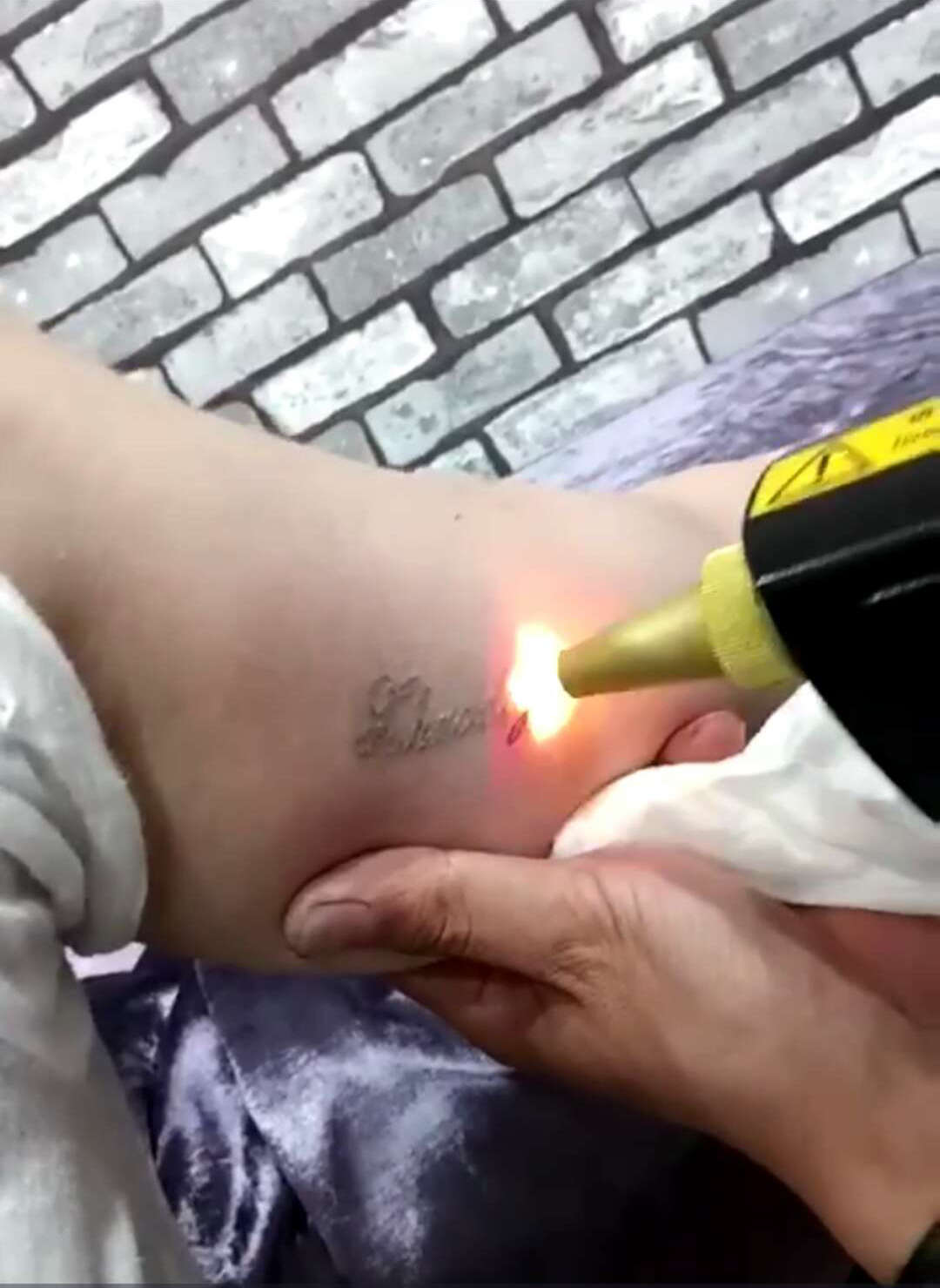 激光洗纹身